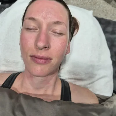 Client complexion results after professional facial at Cranky Crow Aesthetics Melbourne FL